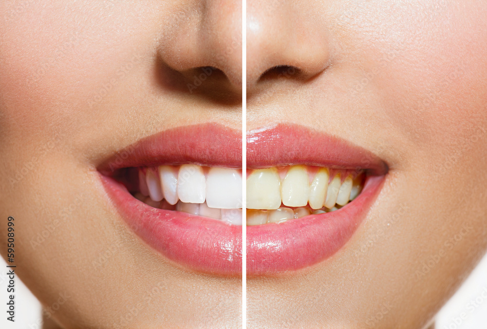 Fototapeta premium Zęby kobiety przed i po wybielaniu. Higiena jamy ustnej