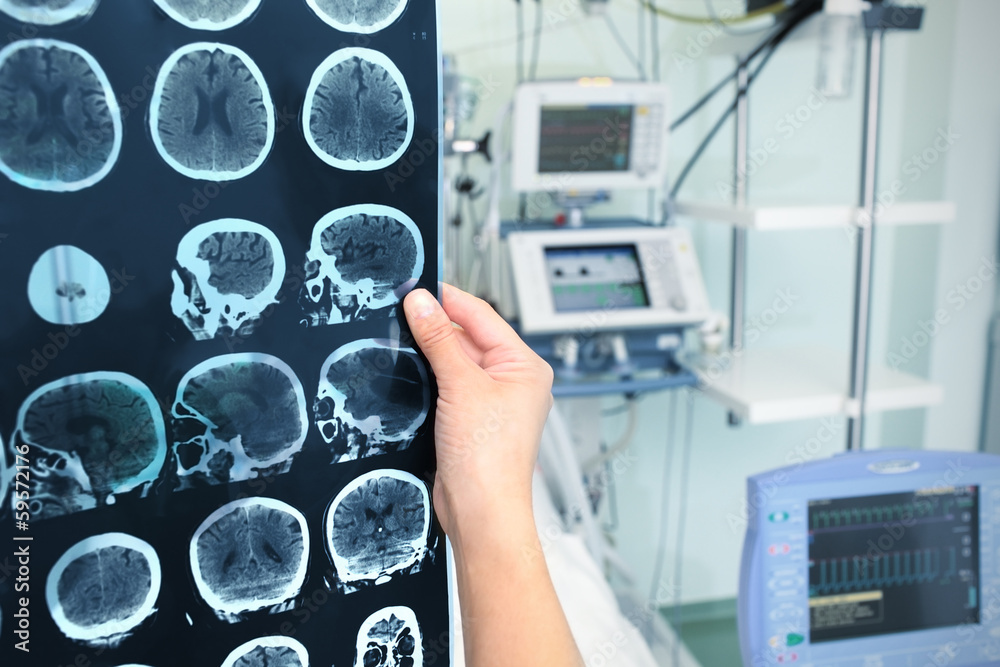 Interpretation of tomography of the brain in the ICU Stock Photo ...