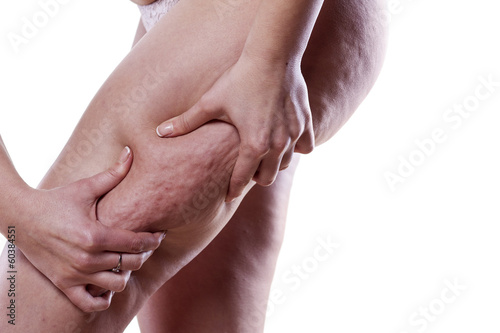 Cuadro en lienzo Young woman holding and pinching cellulite on her leg