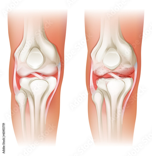 Human knee arthritis