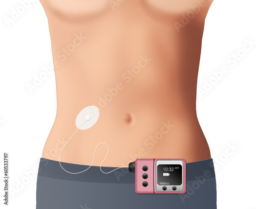 Illustration of an insulin pump with cannula sited on abdomen photo