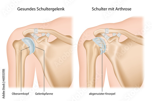 Schulter Arthrose, Omarthrose mit Erklärung deutsch