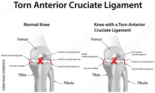 Canvas Print Torn Anterior Cruciate Ligament