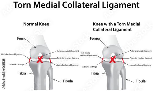 Torn Medial Collateral Ligament