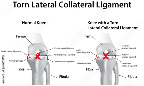 Torn Lateral Collateral Ligament photo