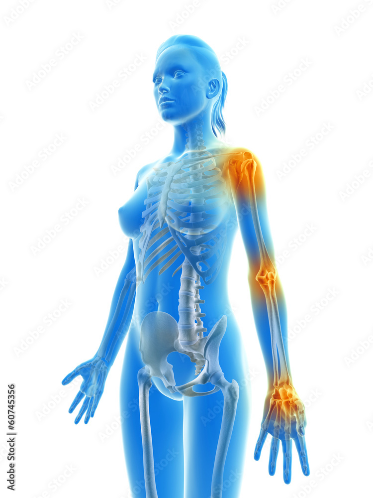 painful arm joints of a female