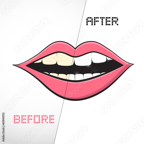 Cleaning Teeth, Before and After