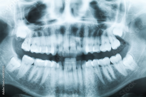 X-ray image of teeth and mouth with four molars