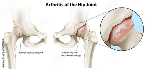 Arthritis of the hip joint photo
