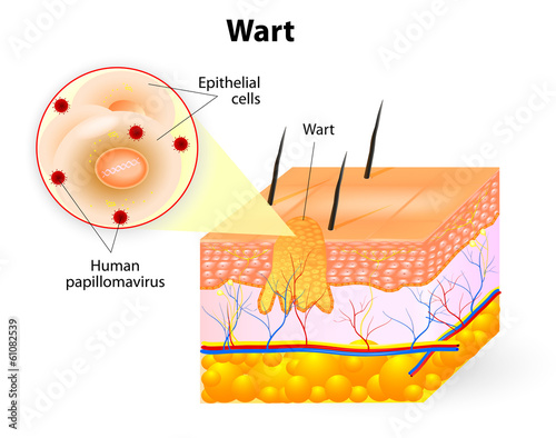 anatomy of Wart photo