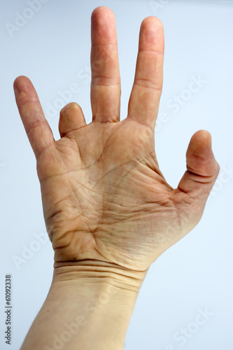 Amputated finger