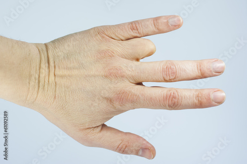 Amputated finger