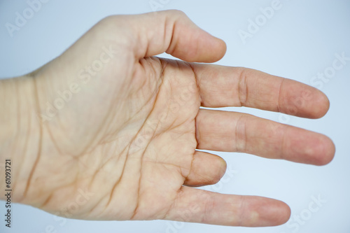 Amputated finger
