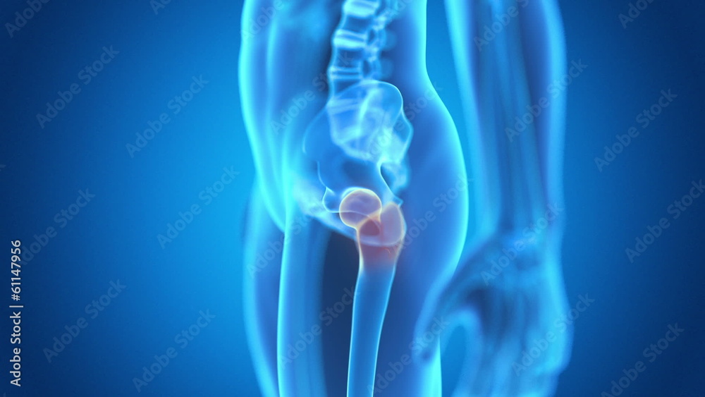medical animaton - painful hip joint medical animaton - painful hip joint