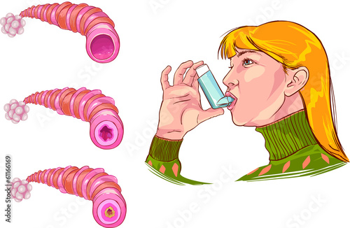 asthma