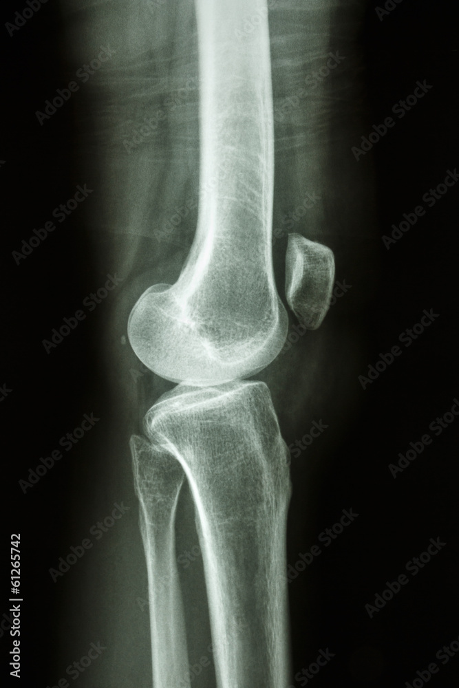 normal human's knee joint normal human's knee joint