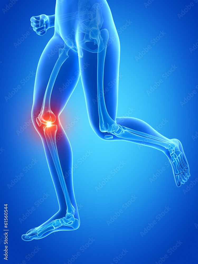 medical 3d illustration - jogger´s painful knee