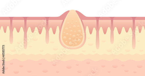 Pimple on skin