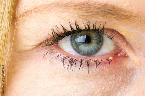 Gereiztes Auge mit Gerstenkorn