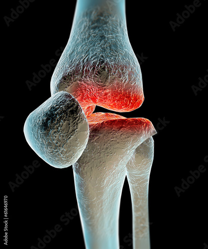 Osteoartrosi, artrosi, malattia ginocchio, ossa photo