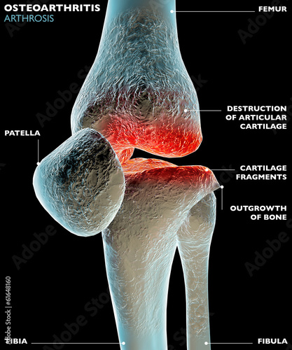 Osteoartrosi, artrosi, malattia ginocchio, ossa photo