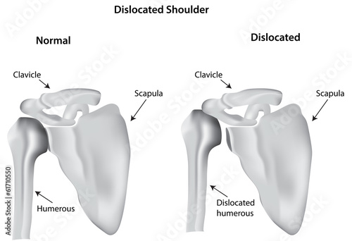 Dislocated Shoulder