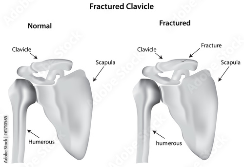 Fractured Clavicle
