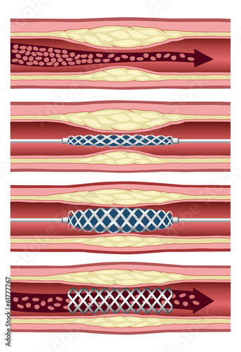 Implanting artery stent in four steps