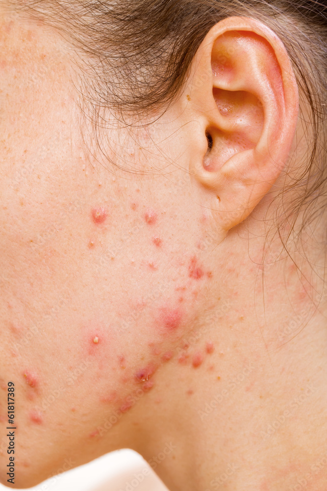 Fototapeta premium Acne skin