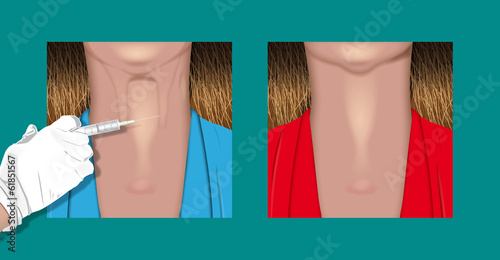 botulinum neck