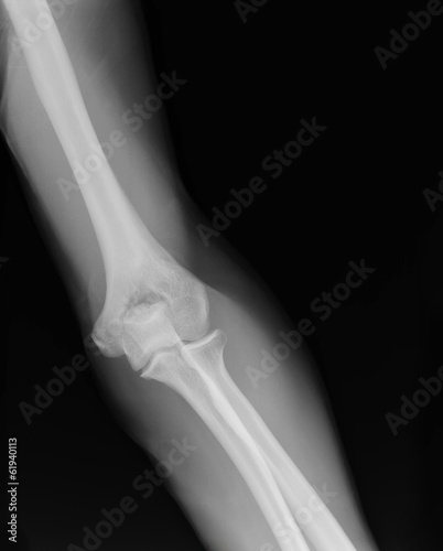 arm  xray