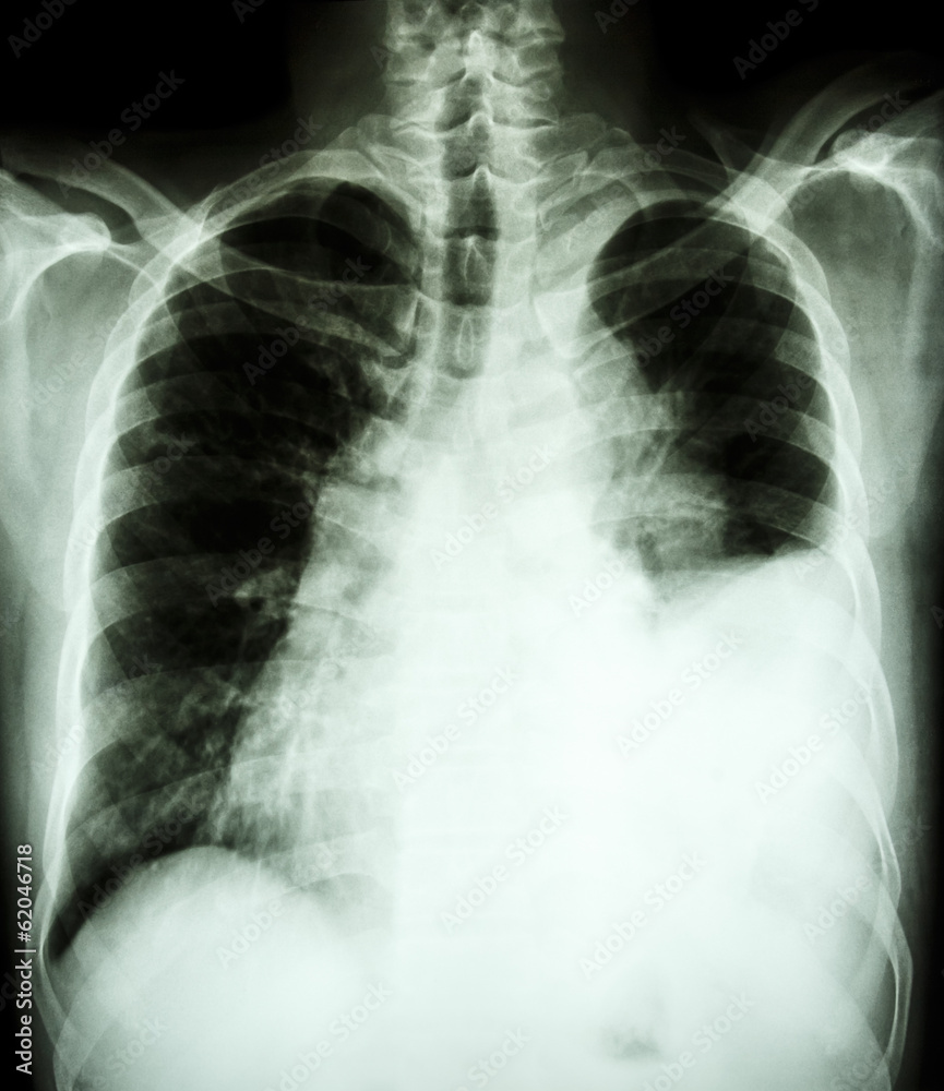 pleural effusion at left lung due to lung cancer pleural effusion at left lung due to lung cancer