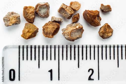 Kidney stones photo