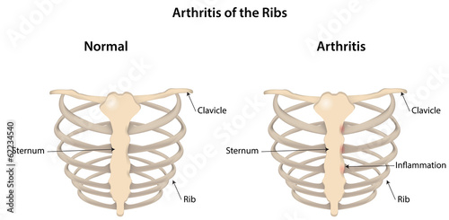 Arthritis of the Ribs Labeled Diagram