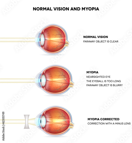 Myopia and normal vision. Myopia is being shortsighted.