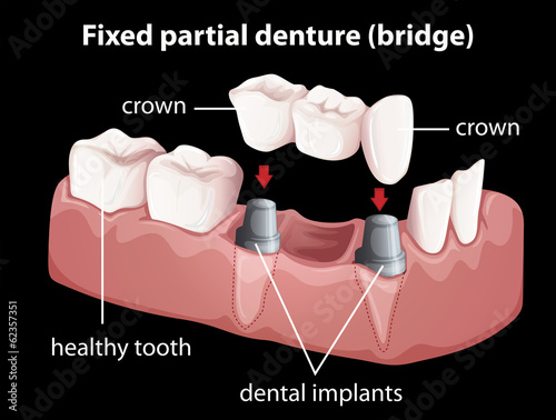 A fixed partial denture