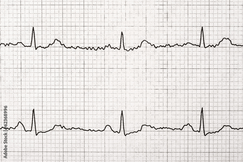 Normal Electrocardiogram Record On Paper