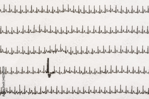 Extrasystole On Electrocardiogram Record Paper photo