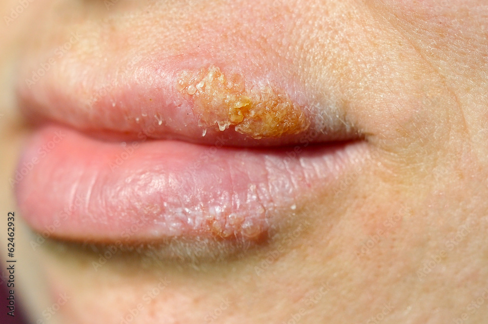 herpes herpes