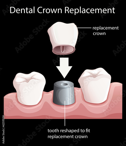 A dental crown replacement