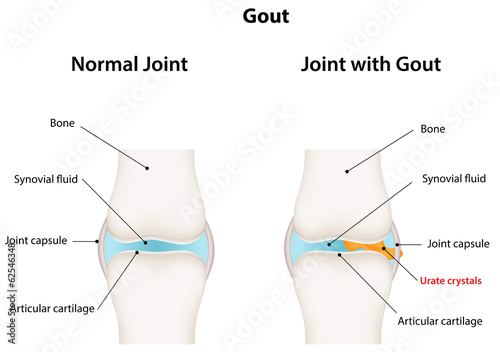 Gout Synovial Joint