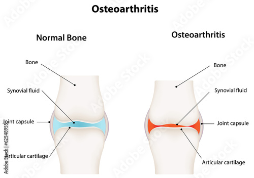 Osteoarthritis Synovial Joint