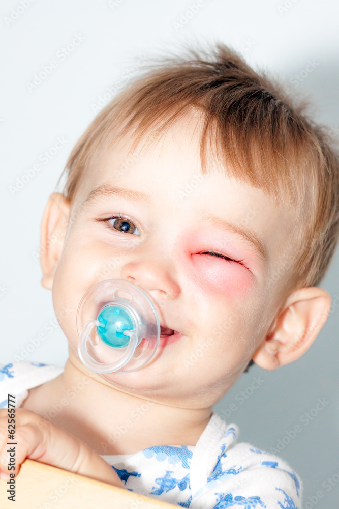Little Boy - Dangerous Stings From Wasps Near The Eye Little Boy - Dangerous Stings From Wasps Near The Eye