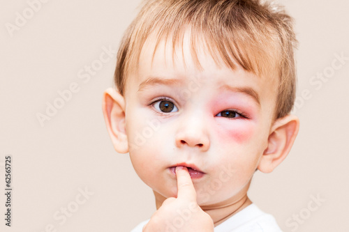 Boy - Dangerous Stings From Wasps Near The Eye - Isolated Image
