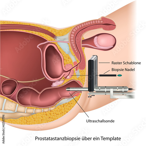 Prostatastanzbiopsie über ein Template