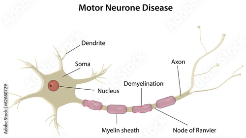 Motor Neurone Disease