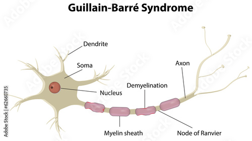 Guillain-Barré Syndrome