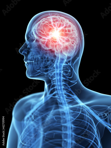 medical illustration of an acute headache