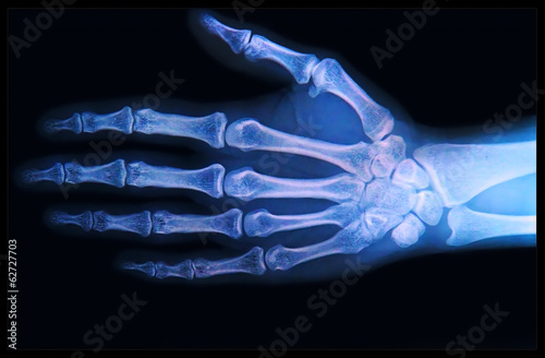 X-ray of Hand and fingers