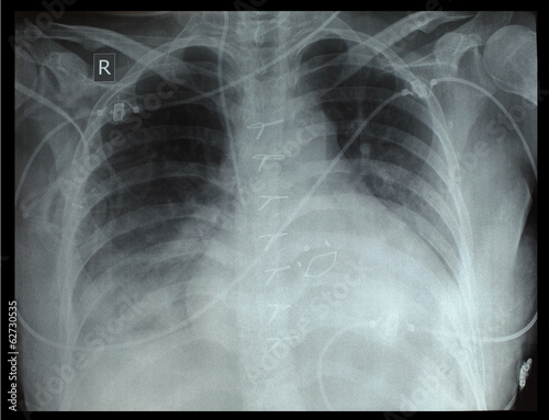 Chest x-ray of the patient after surgery